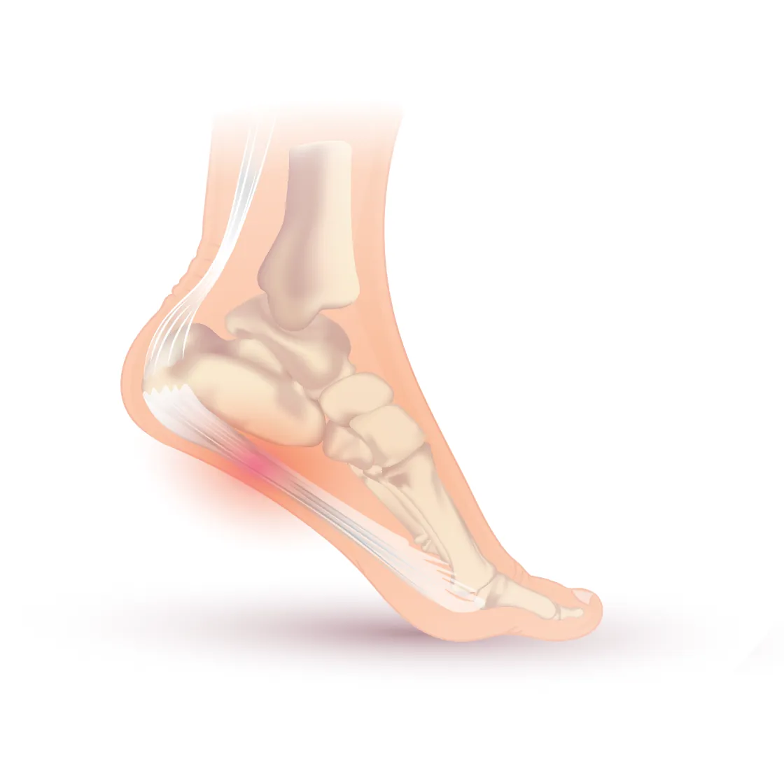 Side view of the foot bones with the plantar fascia running under the arch and a red glow where it attaches near the heel